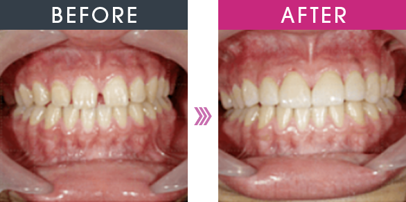 BEFORE AFTER