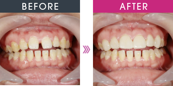 BEFORE AFTER