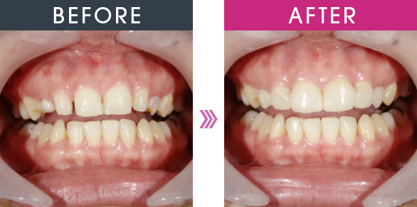 BEFORE AFTER