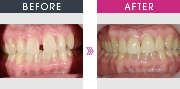 BEFORE AFTER